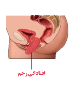افتادگی رحم (طب اسلامی-آیت الله تبریزیان) عطاری مسلمین