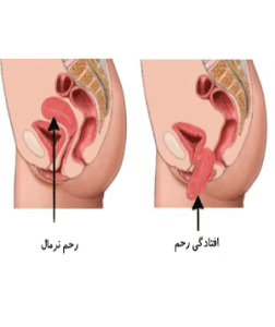 افتادگی رحم--(طب اسلامی-آیت الله تبریزیان) عطاری مسلمین
