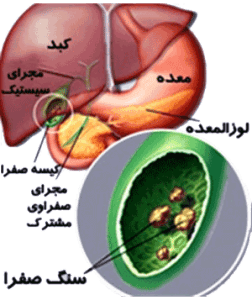 سنگ کیسه صفرا (طب اسلامی-آیت الله تبریزیان) عطاری مسلمین