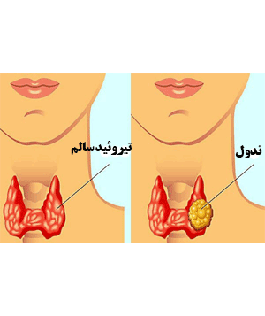 ندول - کیست تیروئید (طب اسلامی-آیت الله تبریزیان) عطاری مسلمین