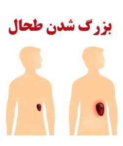 ورم طحال