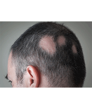 درمان ریزش موی سکه ای در طب اسلامی- درمان گیاهی ریزش مو سکه ای-درمان ریزش مو سکه ای کاملا گیاهی-درمان قطعی ریزش مو طب اسلامی