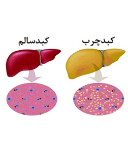 درمان کبد چرب طب اسلامی