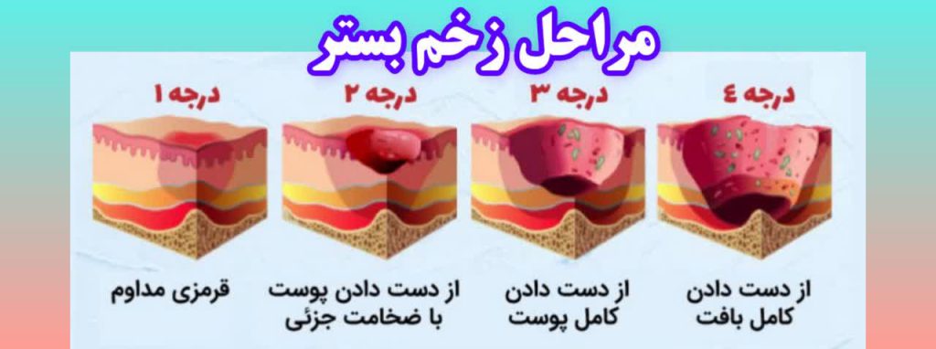 مراحل زخم بستر، گریدهای زخم بستر