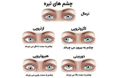 انواع انحراف چشم، درمان انحراف چشم در طب اسلامی، درمان انحراف چشم در طب اسلامی مرکزی (عطاری مسلمین)، درمان انحراف چشم آبت الله تبریزیان