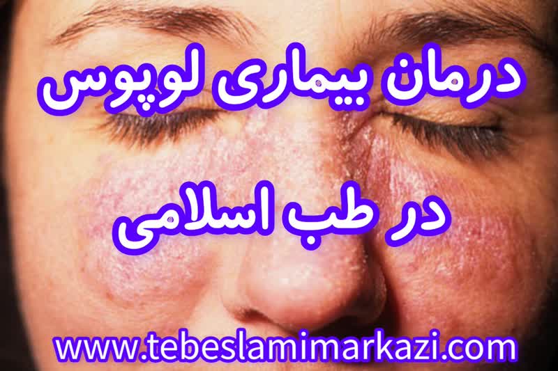 درمان لوپوس در طب اسلامی، درمان لوپوس آیت الله تبریزیان، درمان لوپوس طب اسلامی مرکزی، درمانل لوپوس طب سنتی