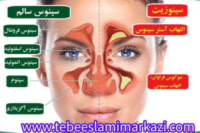 درمان سینوزیت طب اسلامی