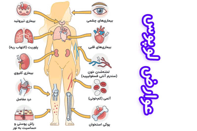 عوارض لوپوس، درمان لوپوس طب اسلامی مرکزی (عطاری مسلمین)