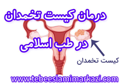 درمان کیست تخمدان در طب اسلامی