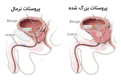 پروستات نرمال-پروستات بزرگ شده