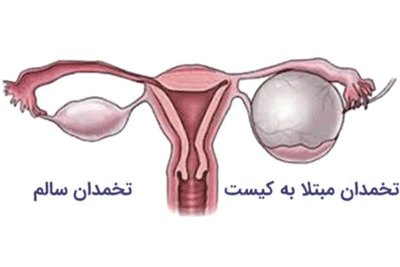 درمان کیست تخمدان طب اسلامی تبریزیان