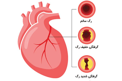 قلب، انواع گرفتگی عروق قلب، درمان انواع گرفتگی عروق قلب
