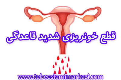 قطع خونریزی شدید قاعدگی طب اسلامی تبریزیان، قطع خونریزی شدید پریودی طب اسلامی تبریزیان، درمان خونریزی شدید قاعدگی طب اسلامی تبریزیان، درمان خونریزی شدید پریودی طب اسلامی تبریزیان،