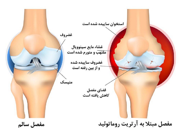 درمان روماتیسم مفصلی در طب اسلامی، درمان خانگی روماتیسم مفصلی در طب اسلامی، درمان روماتیسم مفصلی طب اسلامی تبریزیان