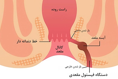 درمان فیستول مقعدی در طب اسلامی تبریزیان بدون نیاز به عمل جراحی