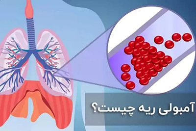 درمان آب آوردن ریه در طب اسلامی بدون نیاز به عمل جراحی توسط استاد تبریزیان