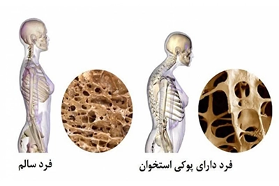 درمان موثر پوکی استخوان در طب اسلامی