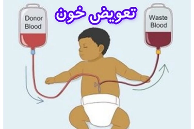 روش تعویض خون برای درمان زردی نوزاد