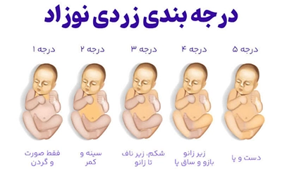 مراحل زردی نوزاد