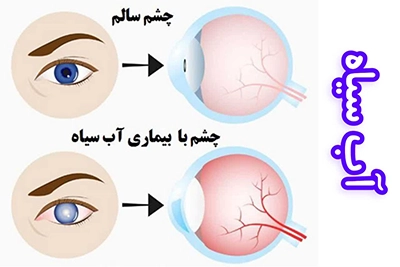 تفاوت چشم سالم و چشم مبتلا به آب سیاه